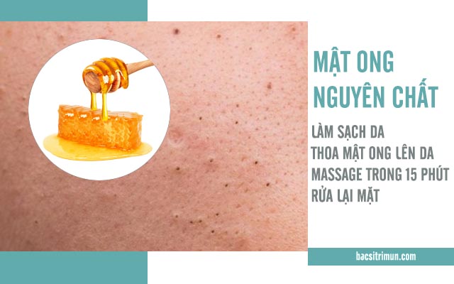 trị mụn đầu đen bằng mật ong nguyên chất