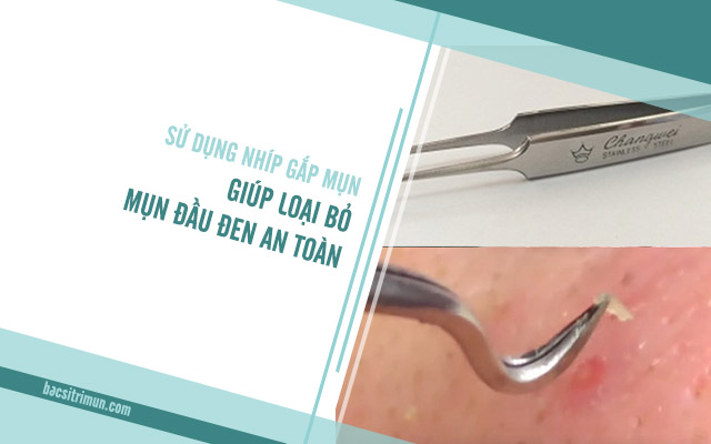 nặn mụn đầu đen đúng cách bằng nhíp gắp mụn