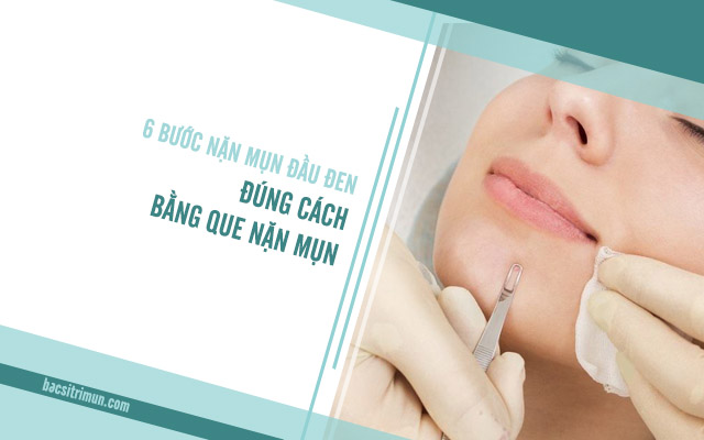 nặn mụn đầu đen đúng cách bằng que nặn mụn