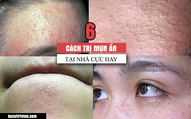 cách trị mụn ẩn tại nhà