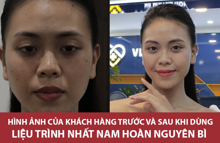 Làn da của chị Trang đã thực sự hồi sinh trở lại sau khi điều trị tại Trung tâm Da liễu Đông y Việt Nam